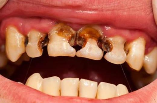 درمان دندان پوسیده با ارتودنسی 