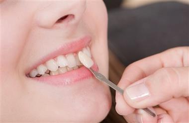 معیار دندانپزشک برای استفاده از کامپوزیت دندان