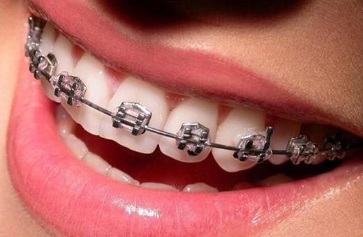 پوسیدگی دندان در حین ارتودنسی