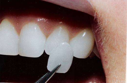 انجام لمینت دندان از واجبات است؟