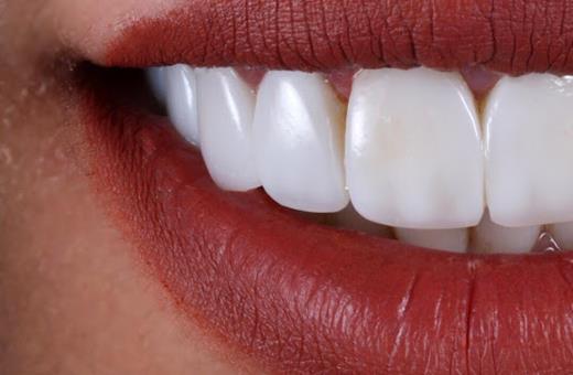 نرخ مناسب کامپوزیت دندان