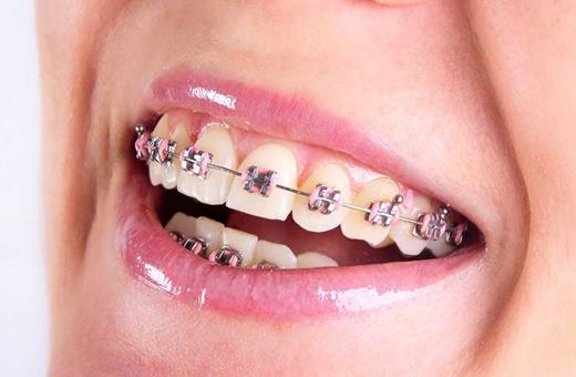 طریقه ارتودنسی دندان