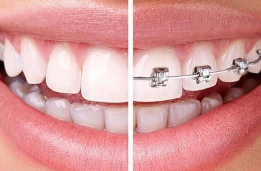 قبل و بعد ارتودنسی دندان