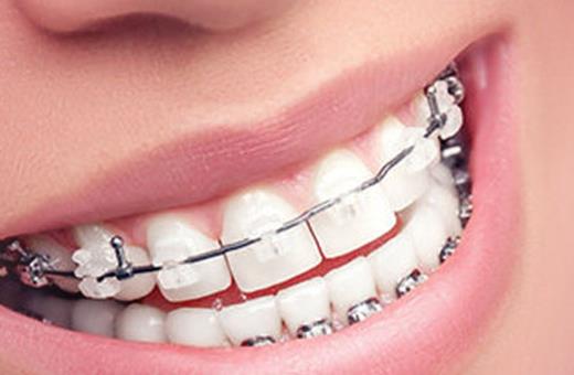 ارتودنسی دندان مناسب چه سنی است؟