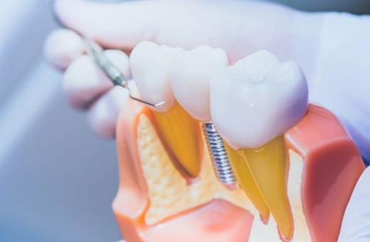 قطعات کاربردی در ایمپلنت دندان