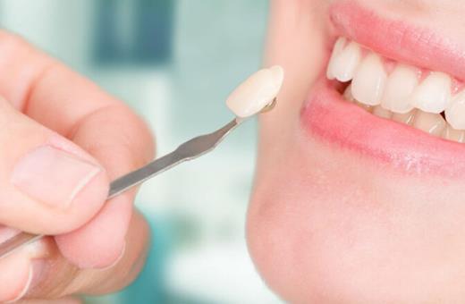 ایرادات لمینت دندان چیست؟