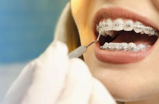 مشاوره انجام ارتودنسی دندان