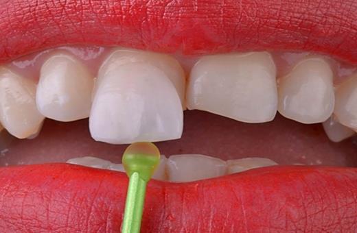 لمینت دندان با کیفیت چه ویژگی دارد؟