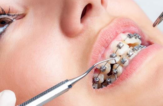 آیا ارتودنسی دندان معایبی دارد؟
