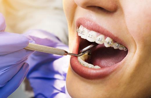 چرا در ارتودنسی دندان را میکشند؟