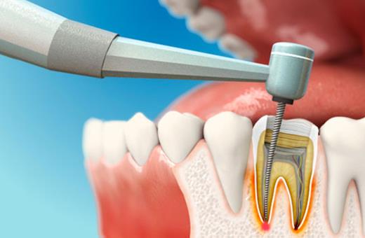 اگر دندان را عصب کشی نکنیم چه میشود؟
