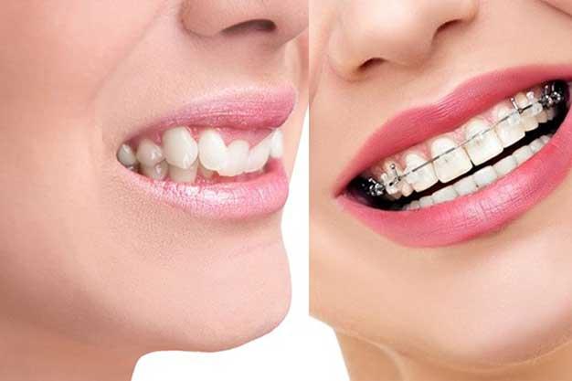    عوامل اثر گذار نتیجه مثبت ارتودنسی دندان