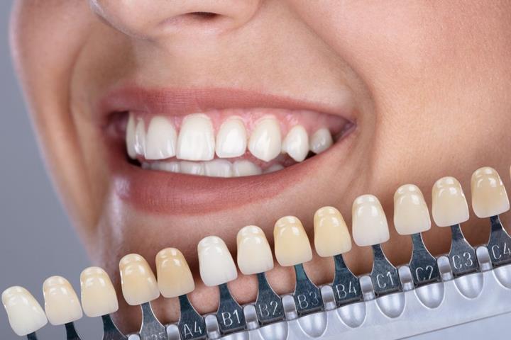 چگونه کامپوزیت دندان را می چسبانند؟