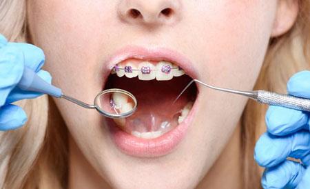 شرایط مراقبت از ارتودنسی دندان