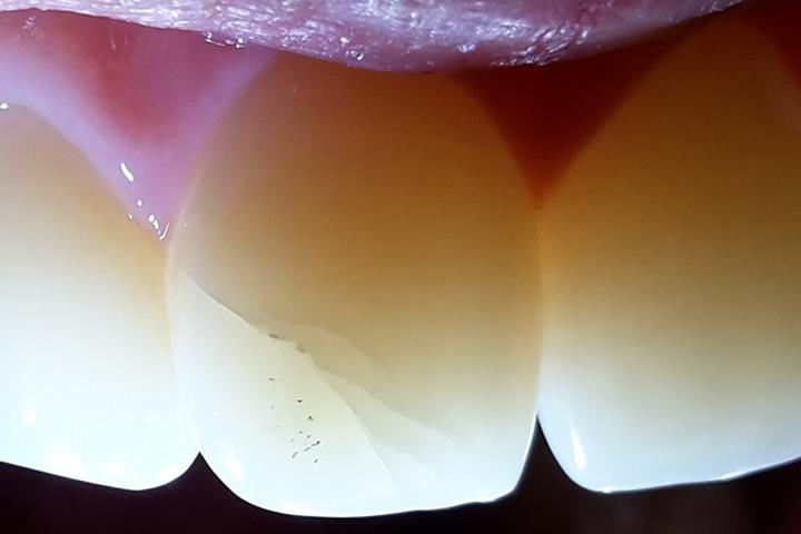 علت ترک خوردن کامپوزیت دندان