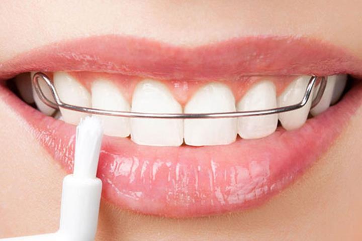 طول درمان ارتودنسی دندان