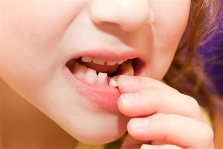 شکستن و ترک خوردن دندان کودک 