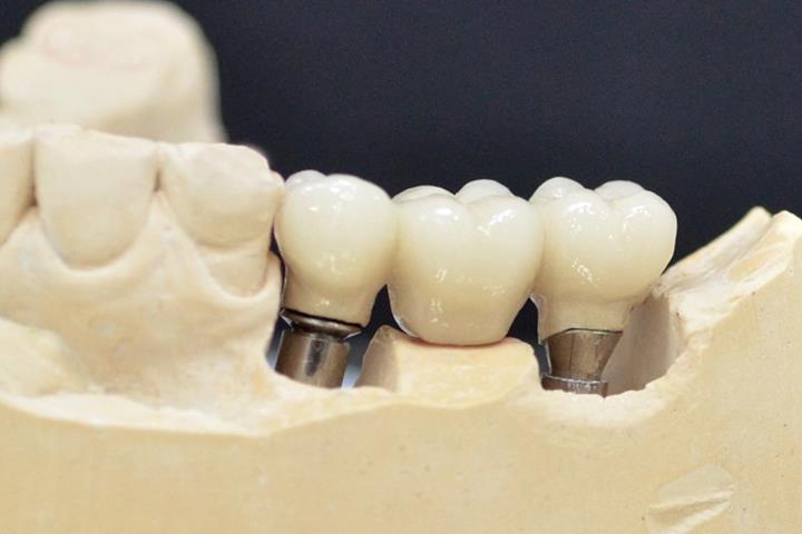 ایمپلنت دندان و هزینه آن