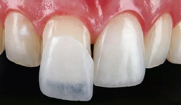 علائم نیاز به کامپوزیت دندان