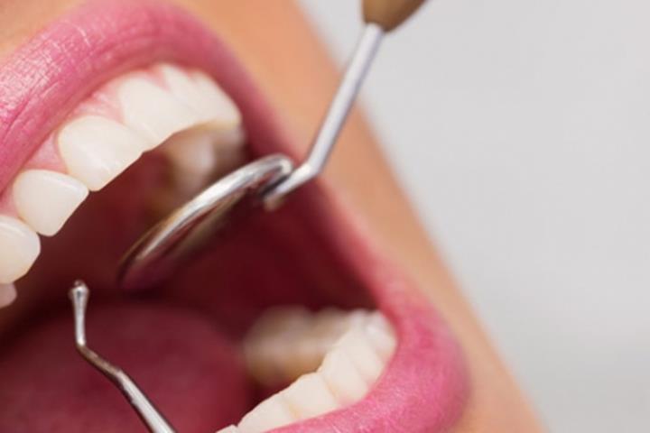 روش منتخب کامپوزیت دندان