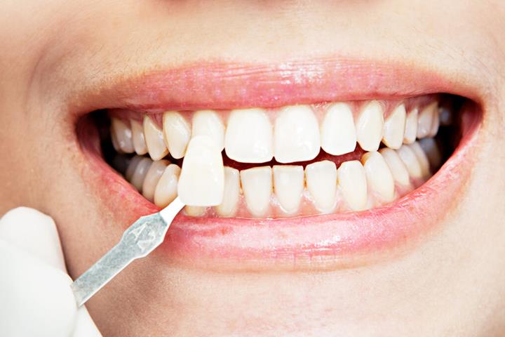 جدا شدن کامپوزیت دندان