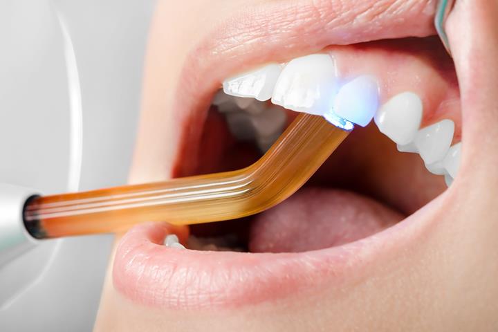 سوالات متداول درباره کامپوزیت دندان