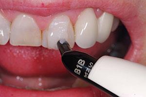 کامپوزیت دندان b1 چیست؟