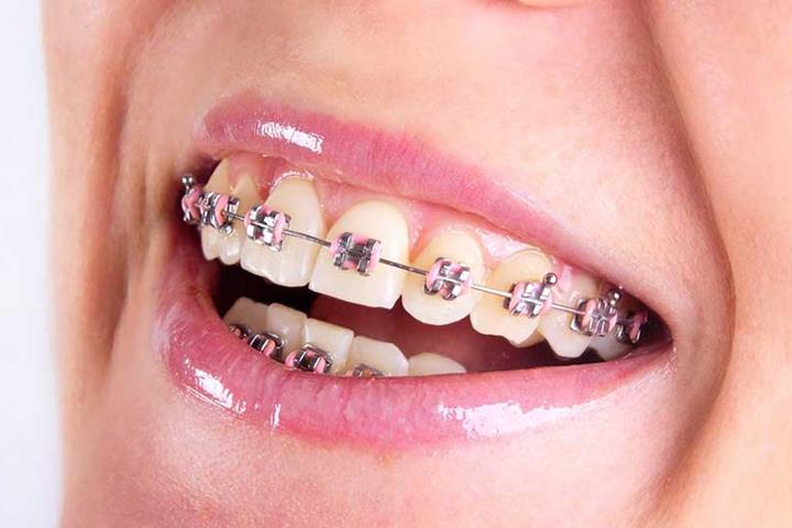 طریقه ارتودنسی دندان