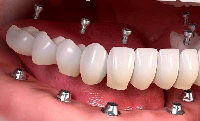 کاربرد ایمپلنت دندان
