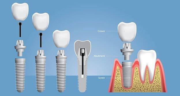 ابزارهای مورد استفاده برای ایمپلنت دندان