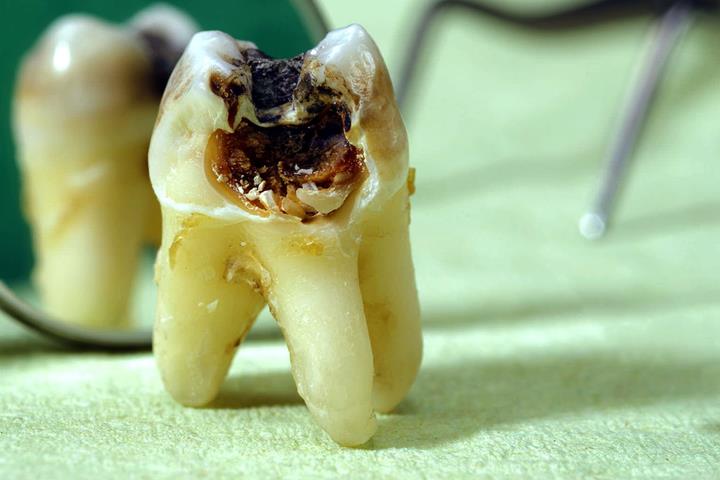 آشنایی با پوسیدگی دندان