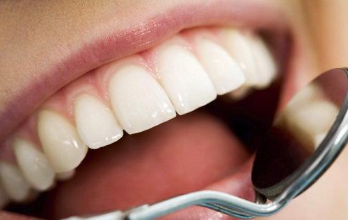لمینت دندان چیست؟