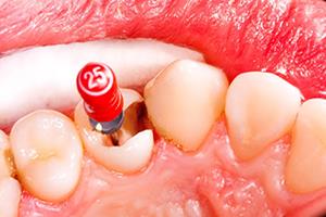 عدم انجام عصب کشی دندان
