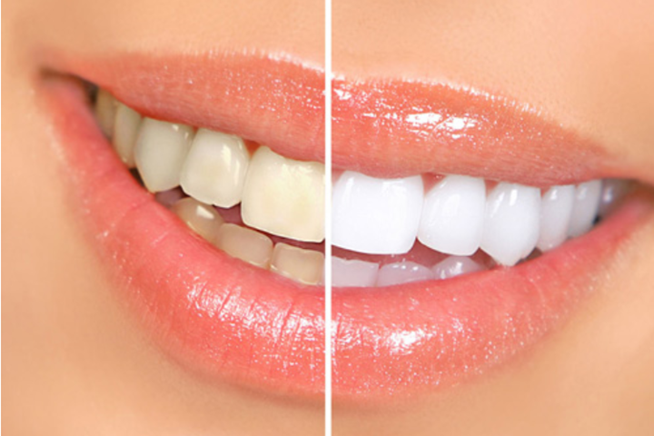 رنگ کامپوزیت دندان مانند رنگ دندان های طبیعی