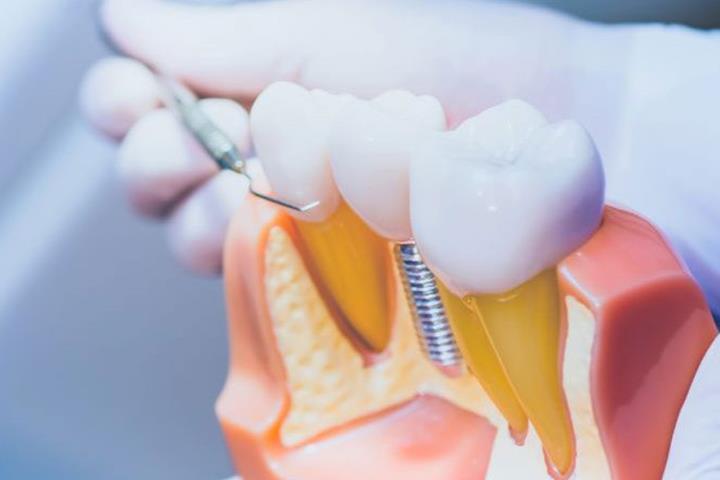 قطعات کاربردی در ایمپلنت دندان
