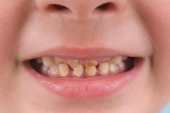 رفع پوسیدگی دندان در دندانپزشکی اطفال