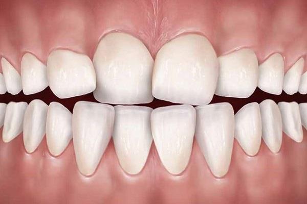 ارتودنسی دندان نامرتب