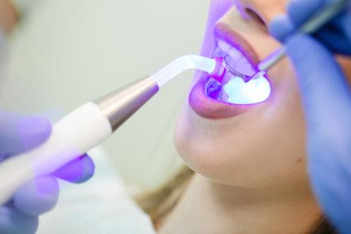 هرآنچه در مورد کامپوزیت دندان باید بدانیم
