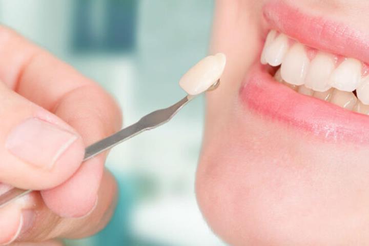 ایرادات لمینت دندان چیست؟