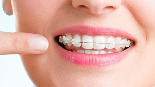 تصورات غلط درباره ارتودنسی دندان
