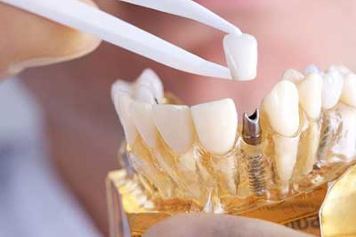 آیا ایمپلنت دندان عوارض دارد؟