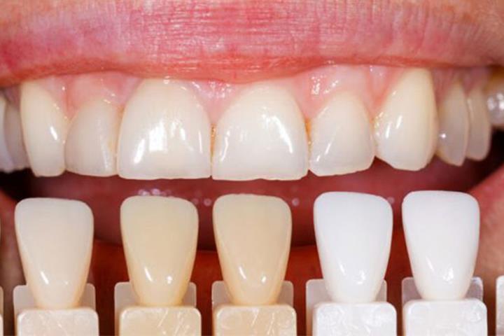 کامپوزیت دندان چند رنگ دارد؟