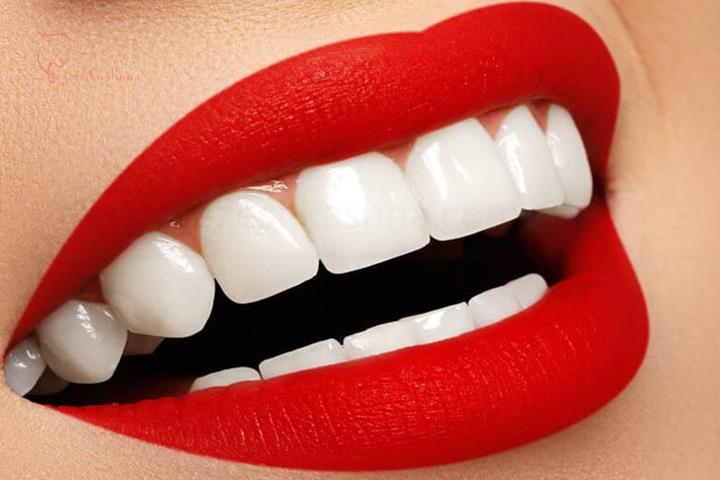 دلیل محبوبیت لمینت دندان چیست؟
