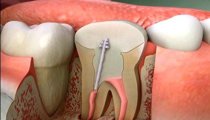 درمان ریشه دندان با پیشرفت دندانپزشکی