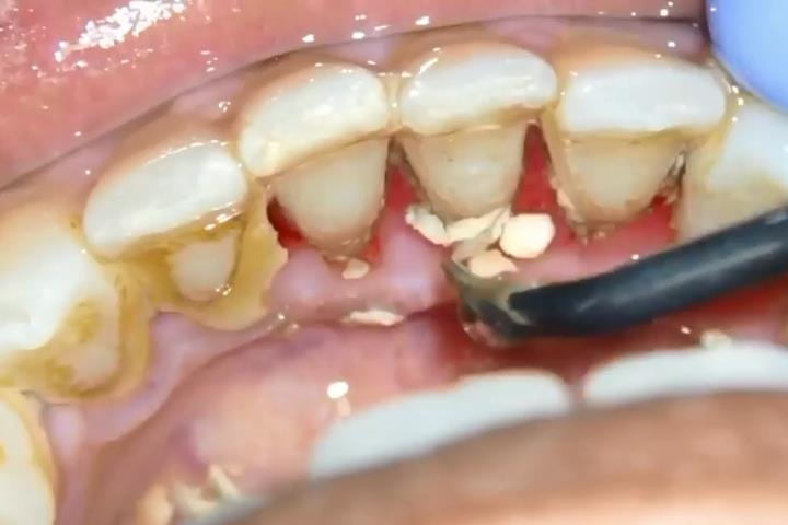 آیا من به جرم گیری دندان نیاز دارم؟