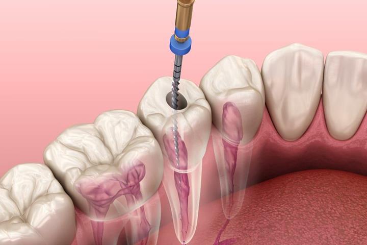 آیا درمان ریشه دندان دردناک است؟