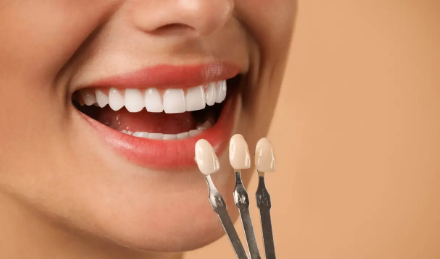 لمینت دندان