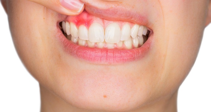 روش درمان آبسه دندان