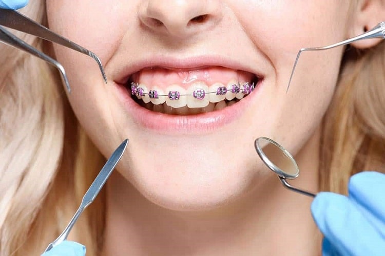 مشاوره ارتودنسی دندان