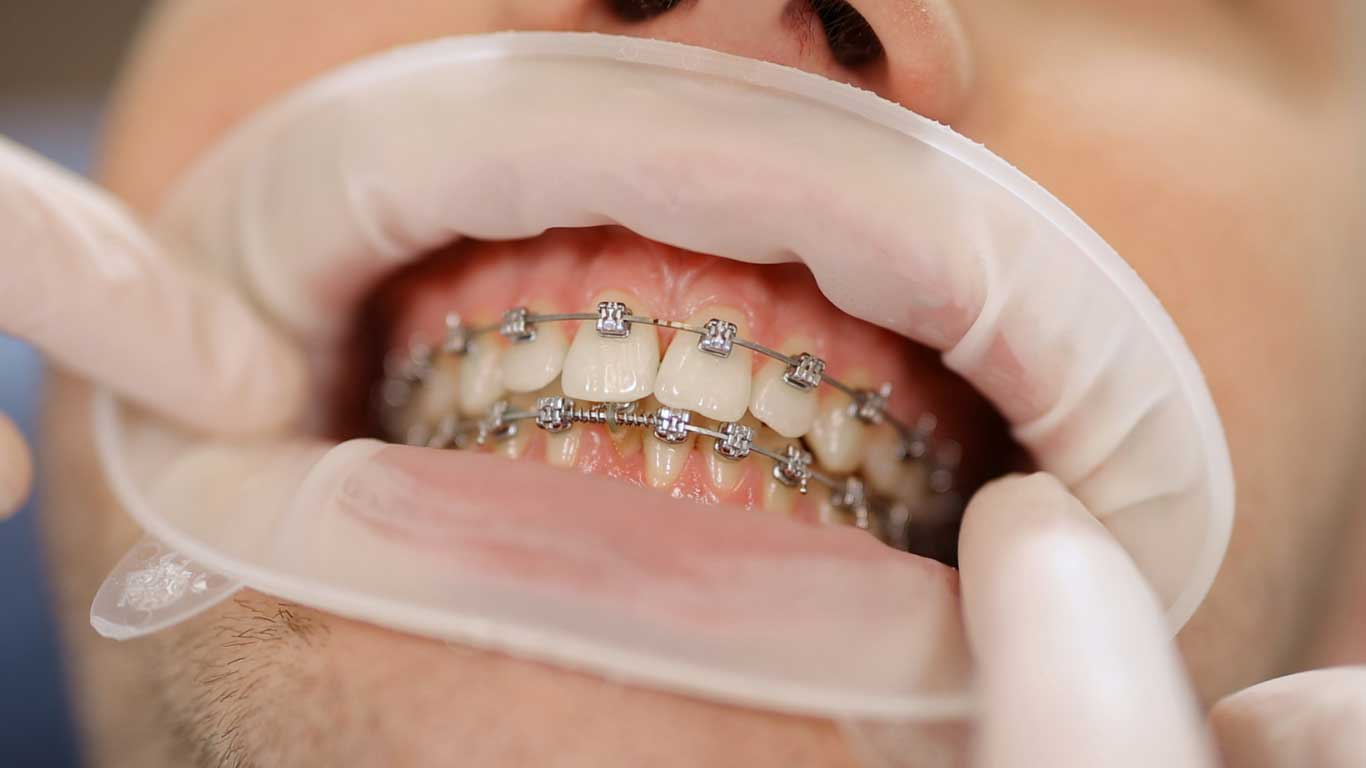 ارتودنسی دندان